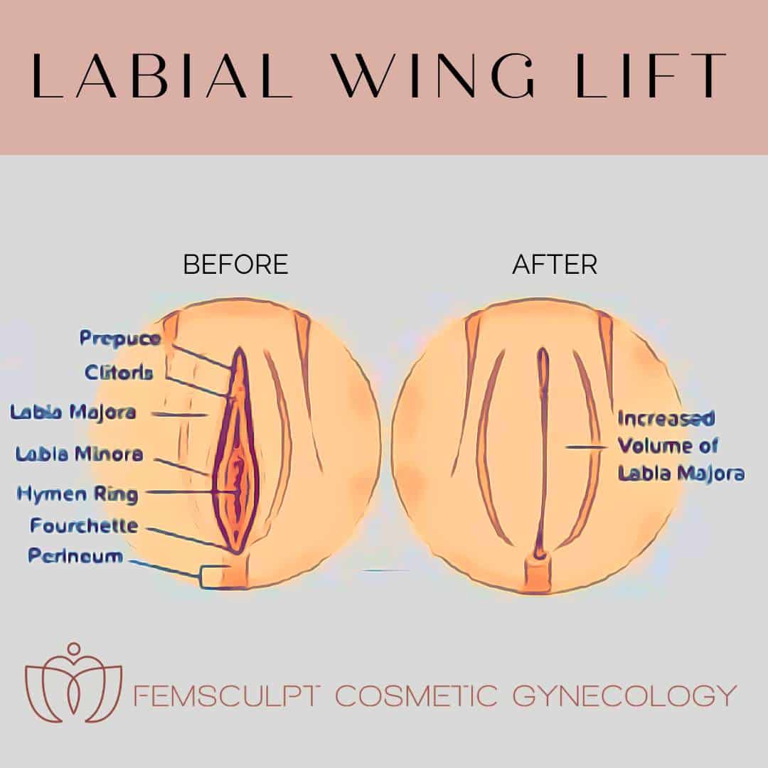 Labial wing lift illustration femsculpt cosmetic gynecology