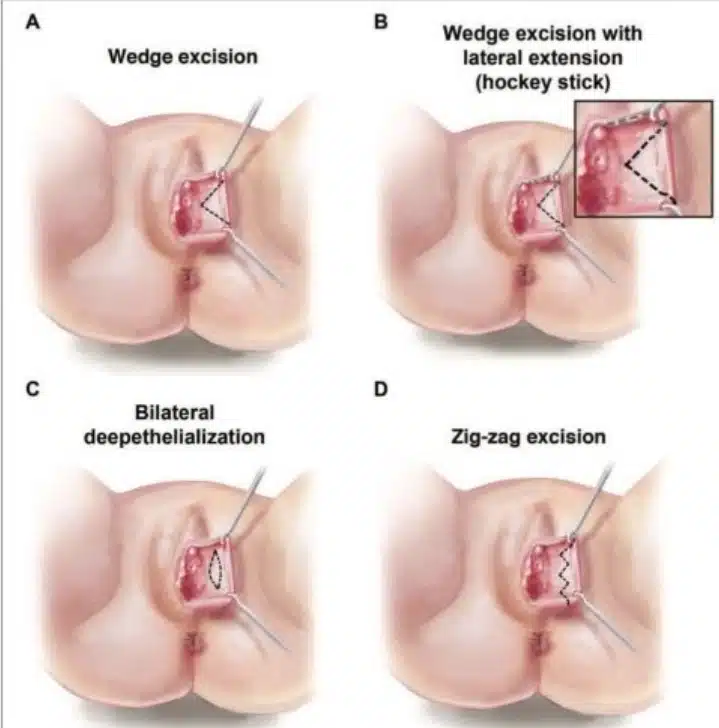 A series of images showing the stages of a pelvic girdle reconstruction surgery.
