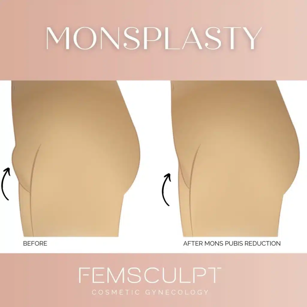 A woman's mons pubis before and after a femscult procedure.