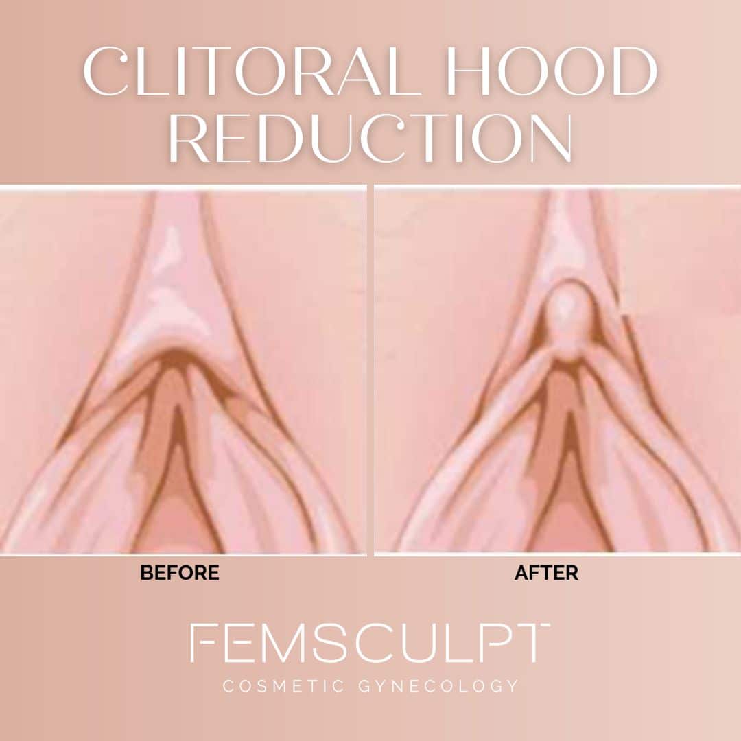 What is a clitoral hood reduction?