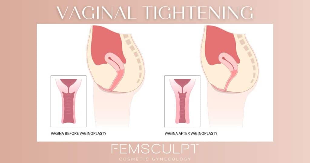 Vaginal tightening surgery near me - femsculpt cosmetic gynecology
