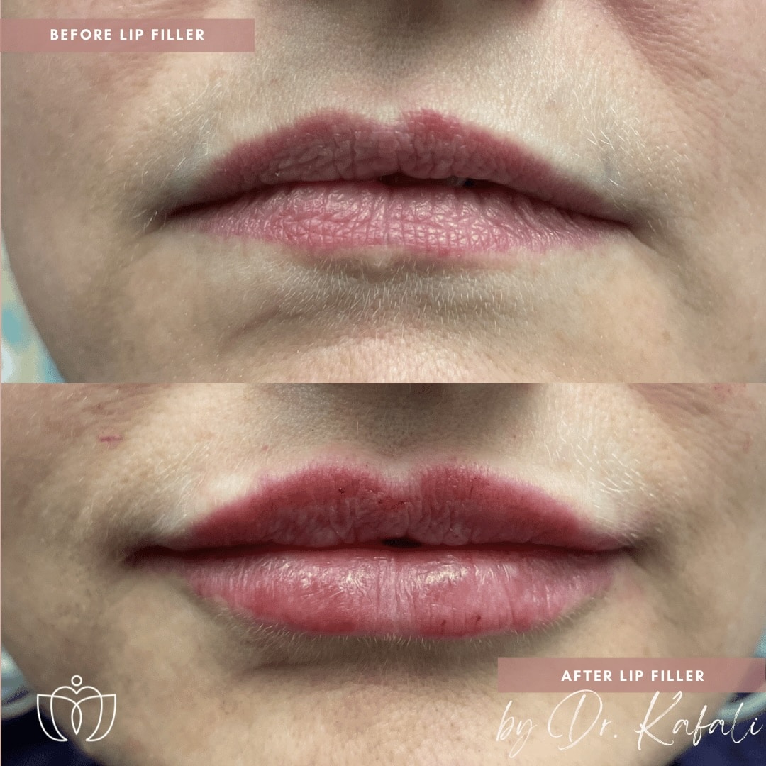 before-after-lip-filler-injections-dr-sue-kafali-chicago-femsculpt