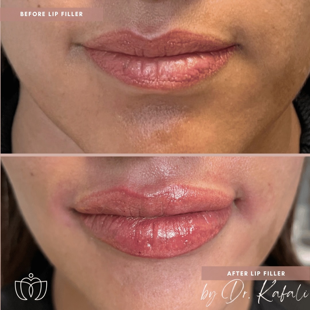 before-after-lip-filler-injections-dr-sue-kafali-chicago-femsculpt