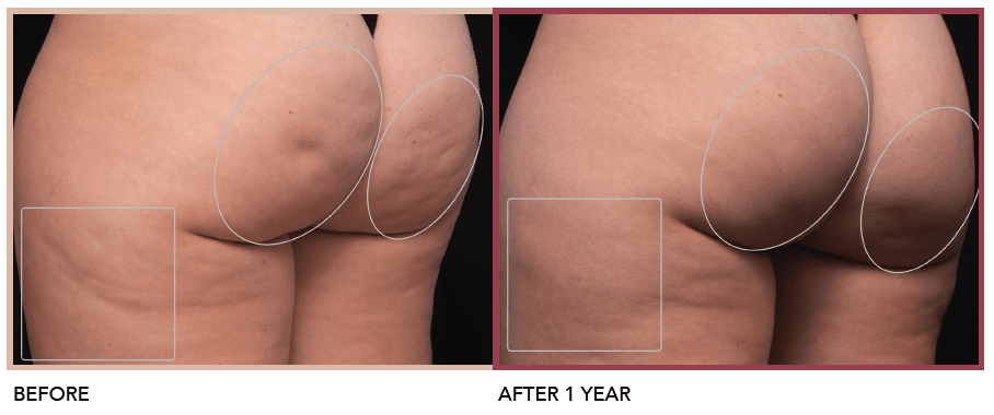 Before and after pictures showcasing cellulite treatment on a woman's butt.