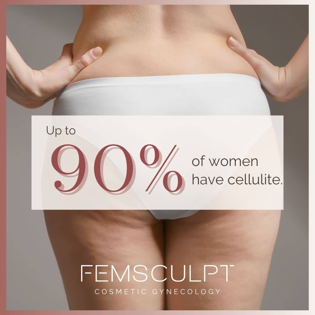 Up to 90% of women have cellulite and may seek treatment options.