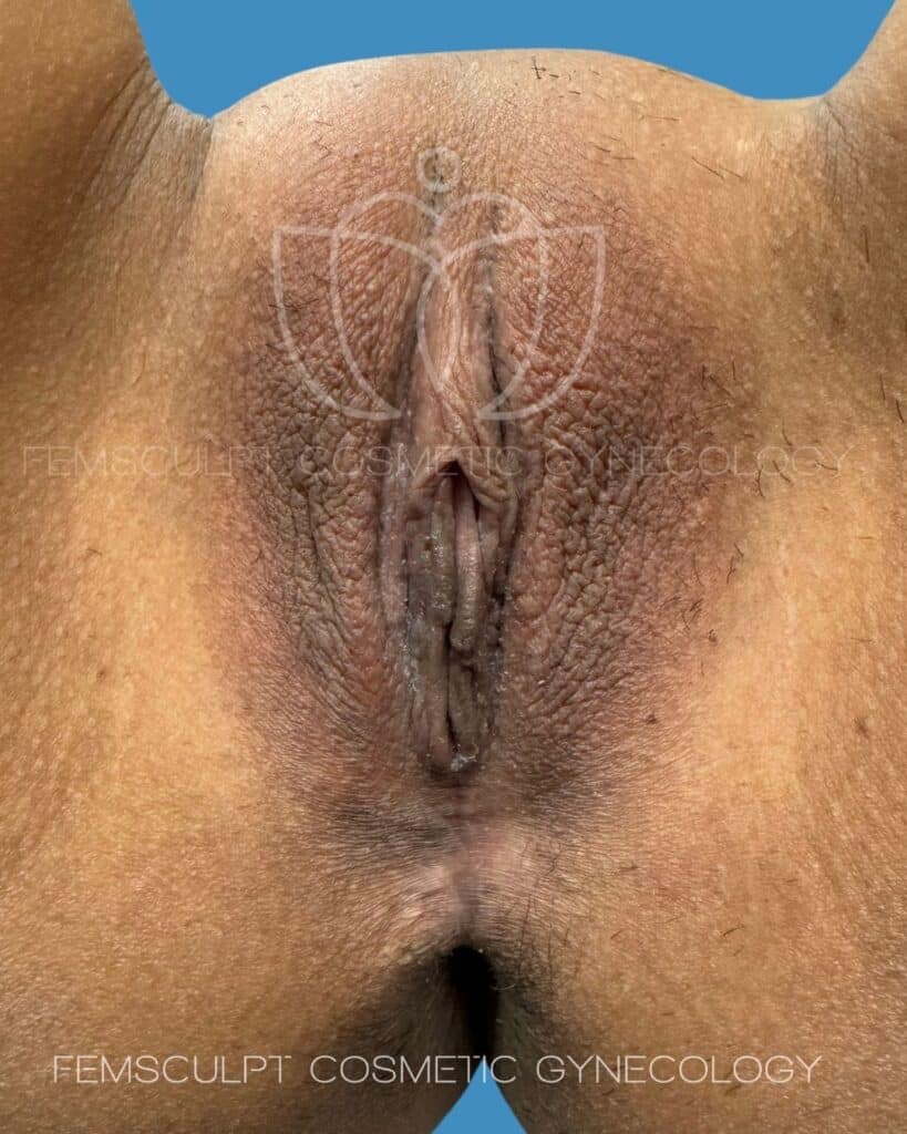 2255391 mini vaginal tightening, labiaplasty, cleft narrowing before dr. Kafali femsculpt