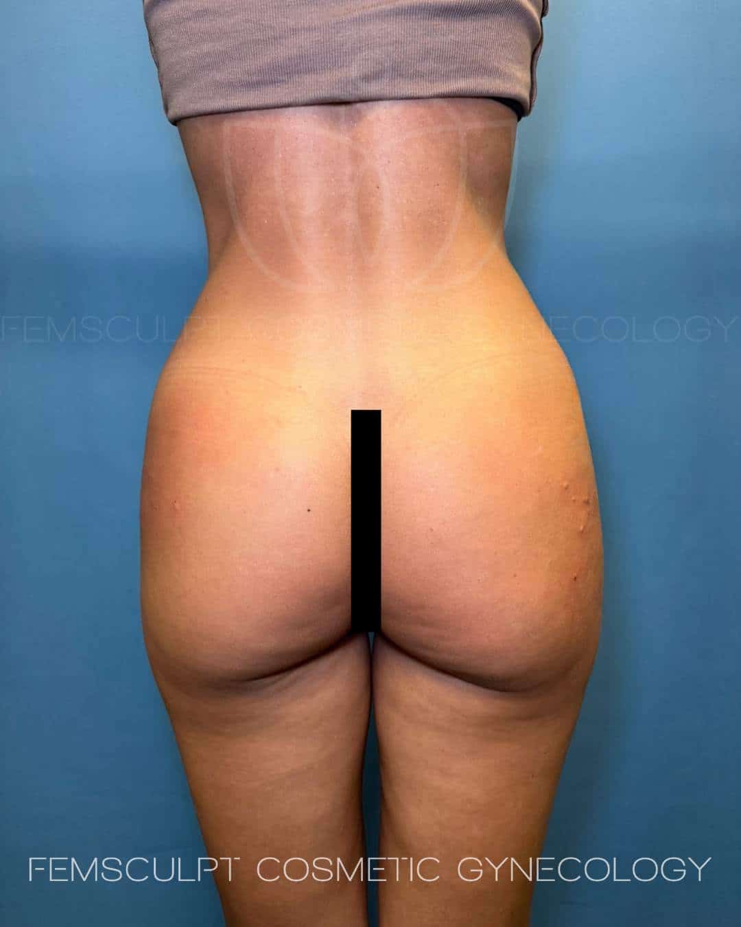 2326305 sculptra buttock injections right after injections dr. Kafali femsculpt