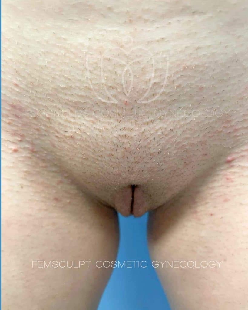 8 weeks before after labiaplasty surgery by dr. Sue kafali in chicago femsculpt 1933525