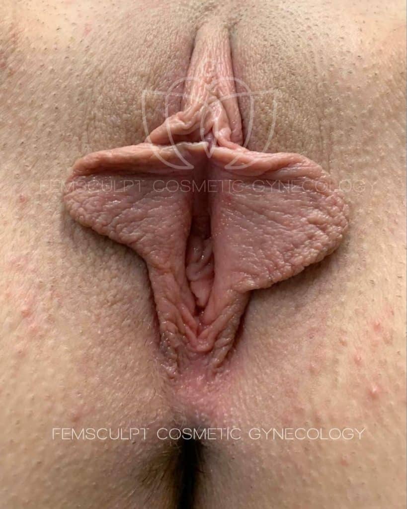 8 weeks before after labiaplasty surgery by dr. Sue kafali in chicago femsculpt 1933525