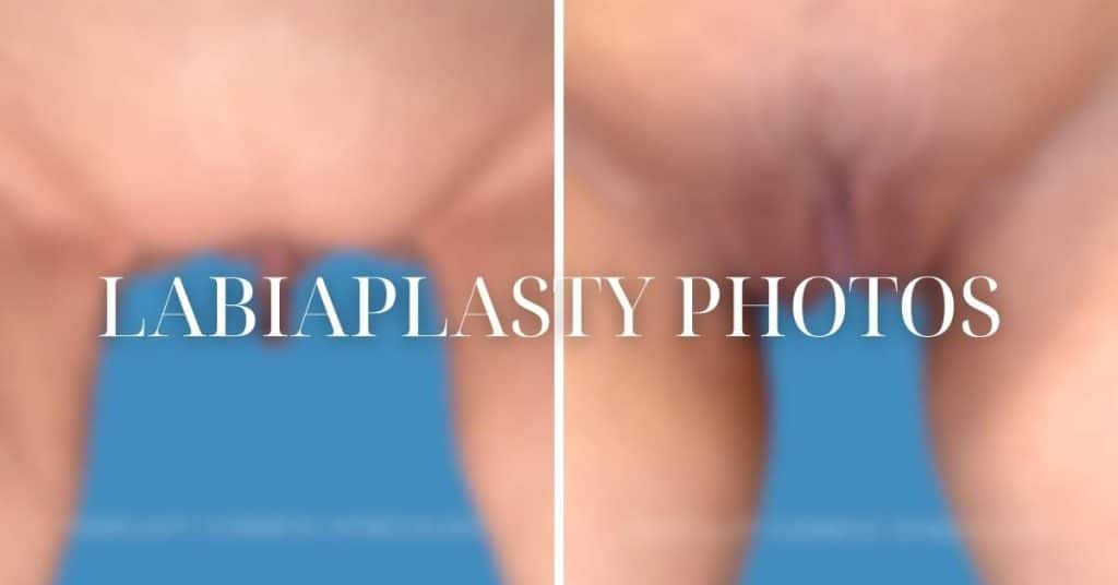 Chicago labiaplasty before after photos