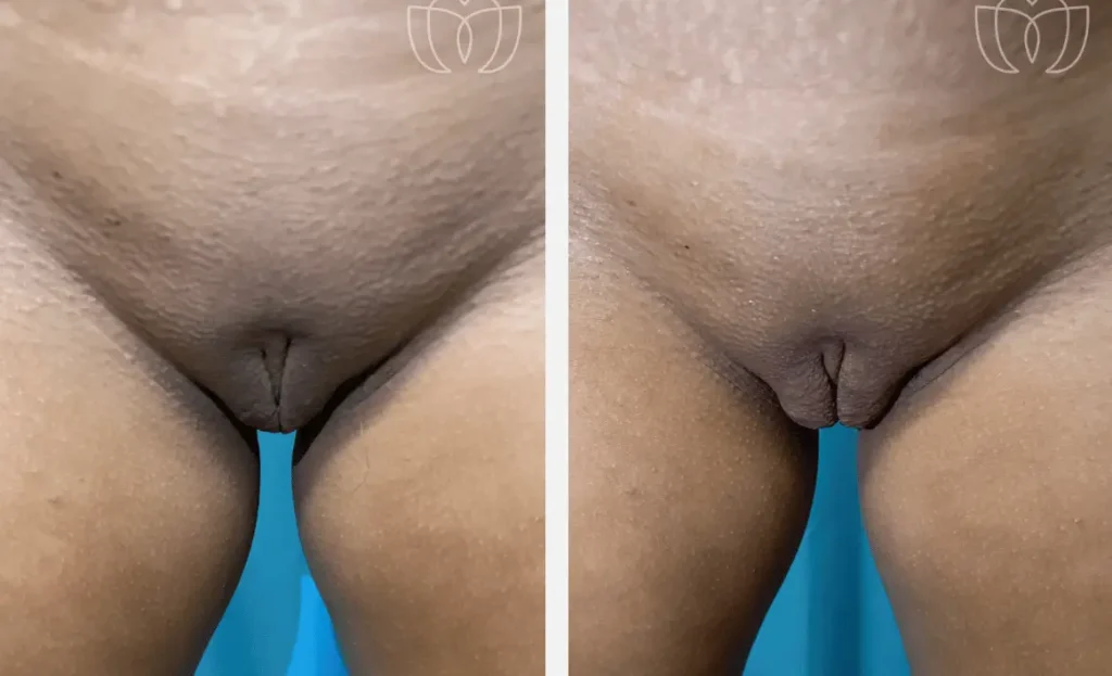 Labial puff filler before after by dr sue kafali chicago 1778554