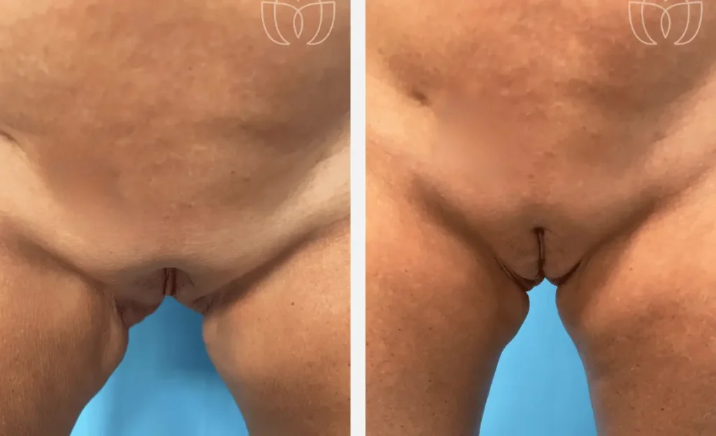 Labial puff filler before after by dr sue kafali chicago 2046793