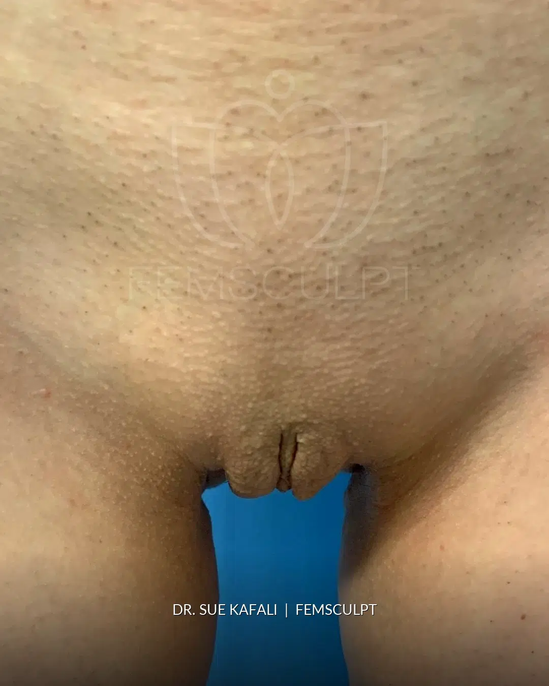 Vaginal Tightening (Vaginoplasty) after photo, case 1879243, FemSculpt Chicago