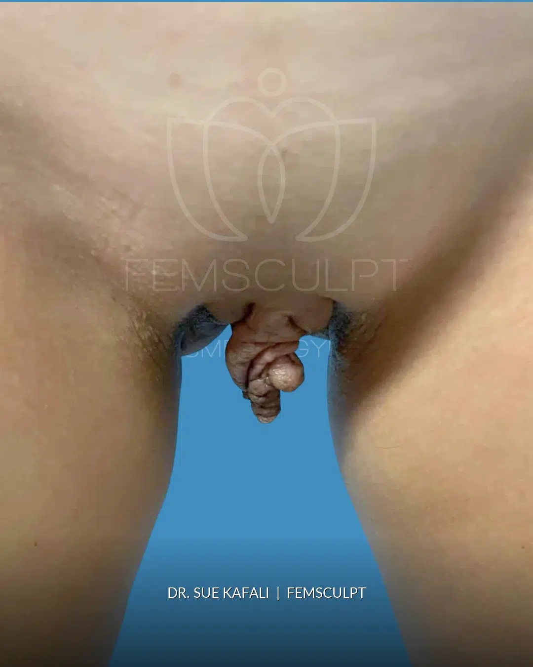 Cleft Narrowing before photo, case 1975996, FemSculpt Chicago