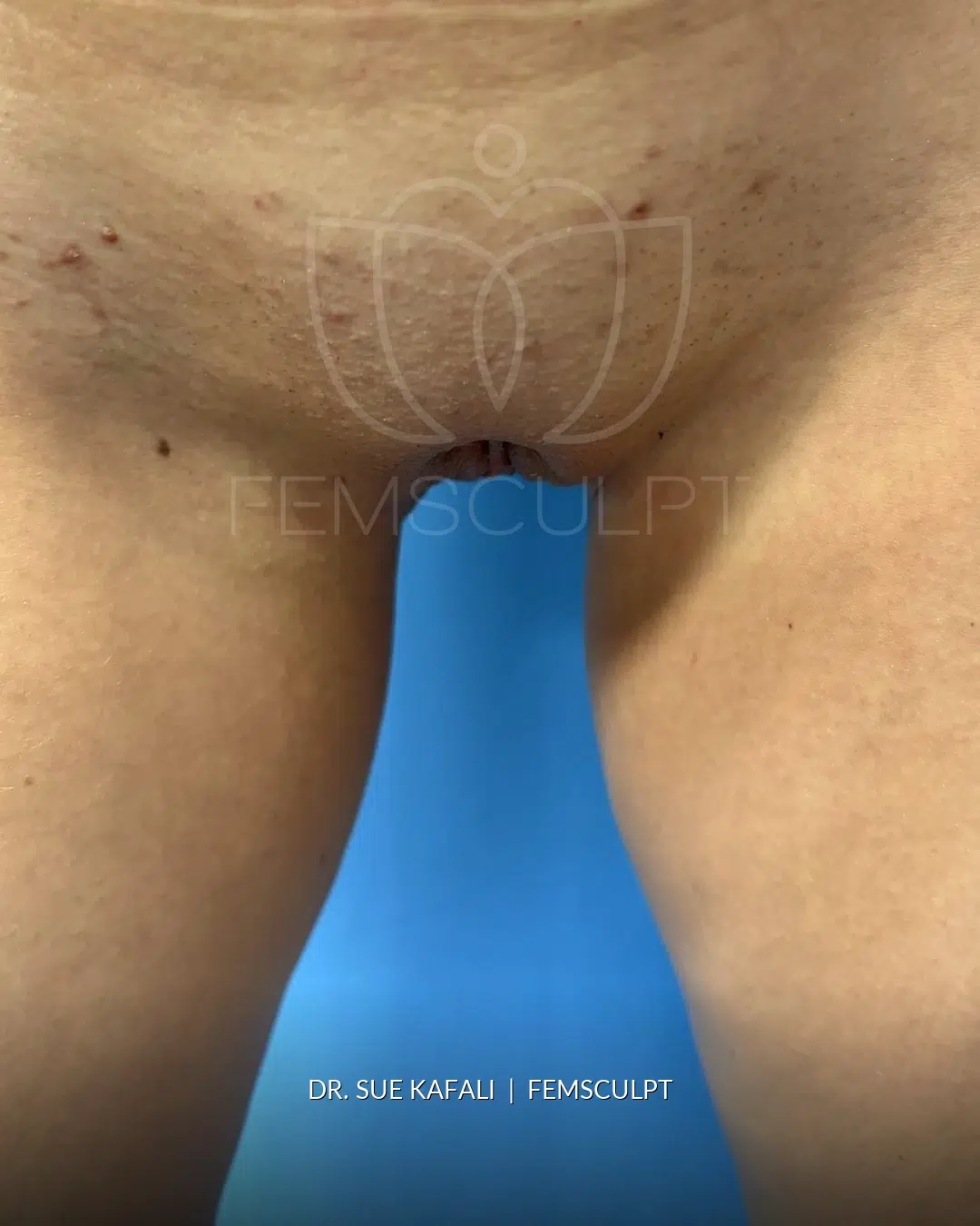 Labiaplasty after photo, case 2274220, FemSculpt Chicago