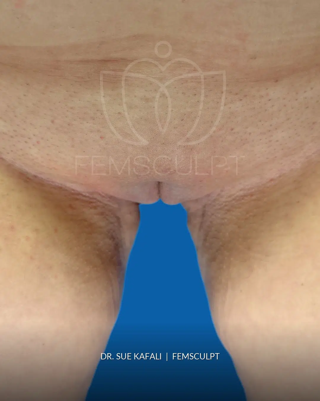 Cleft Narrowing after photo, case 2409934, FemSculpt Chicago