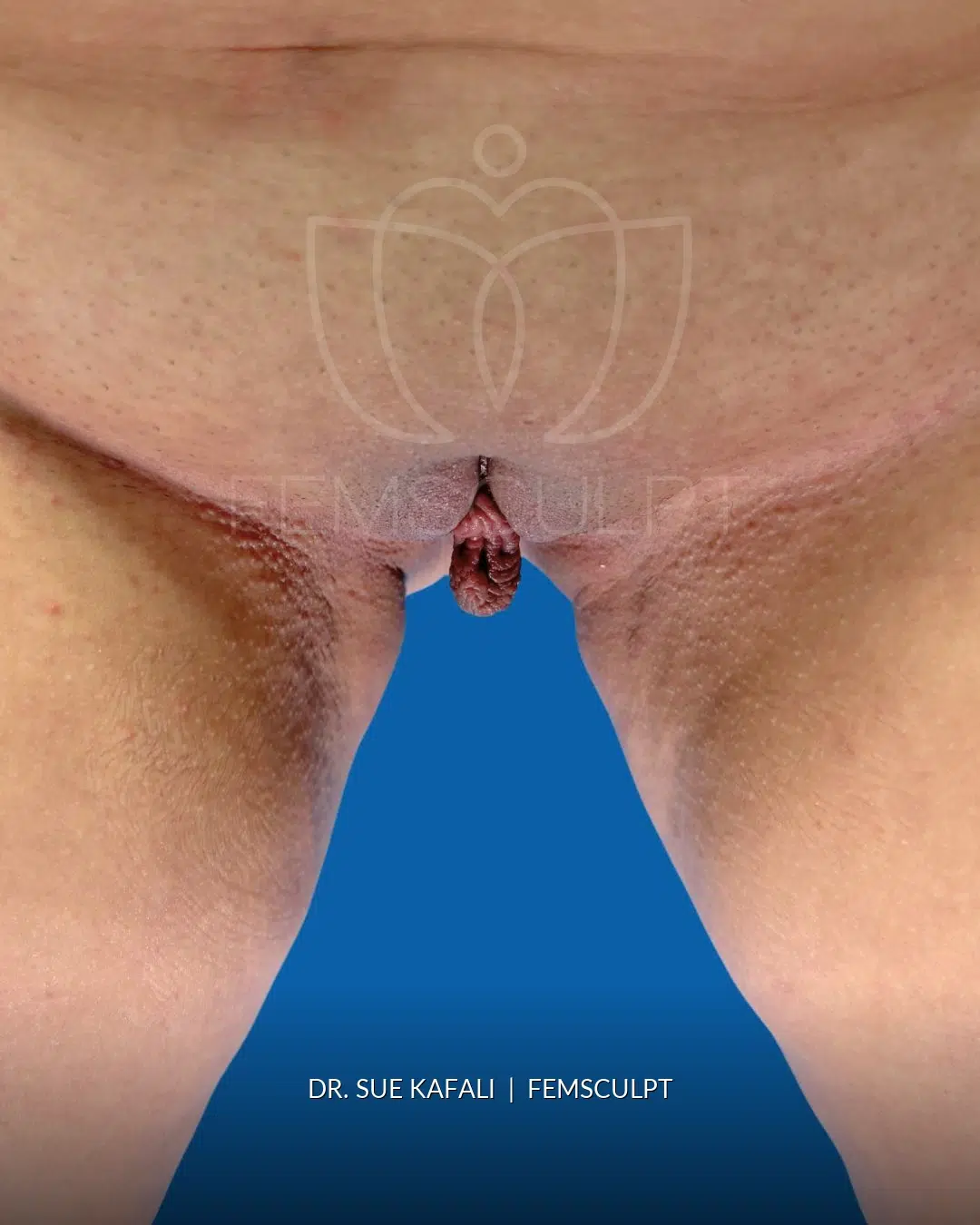 Cleft Narrowing before photo, case 2409934, FemSculpt Chicago
