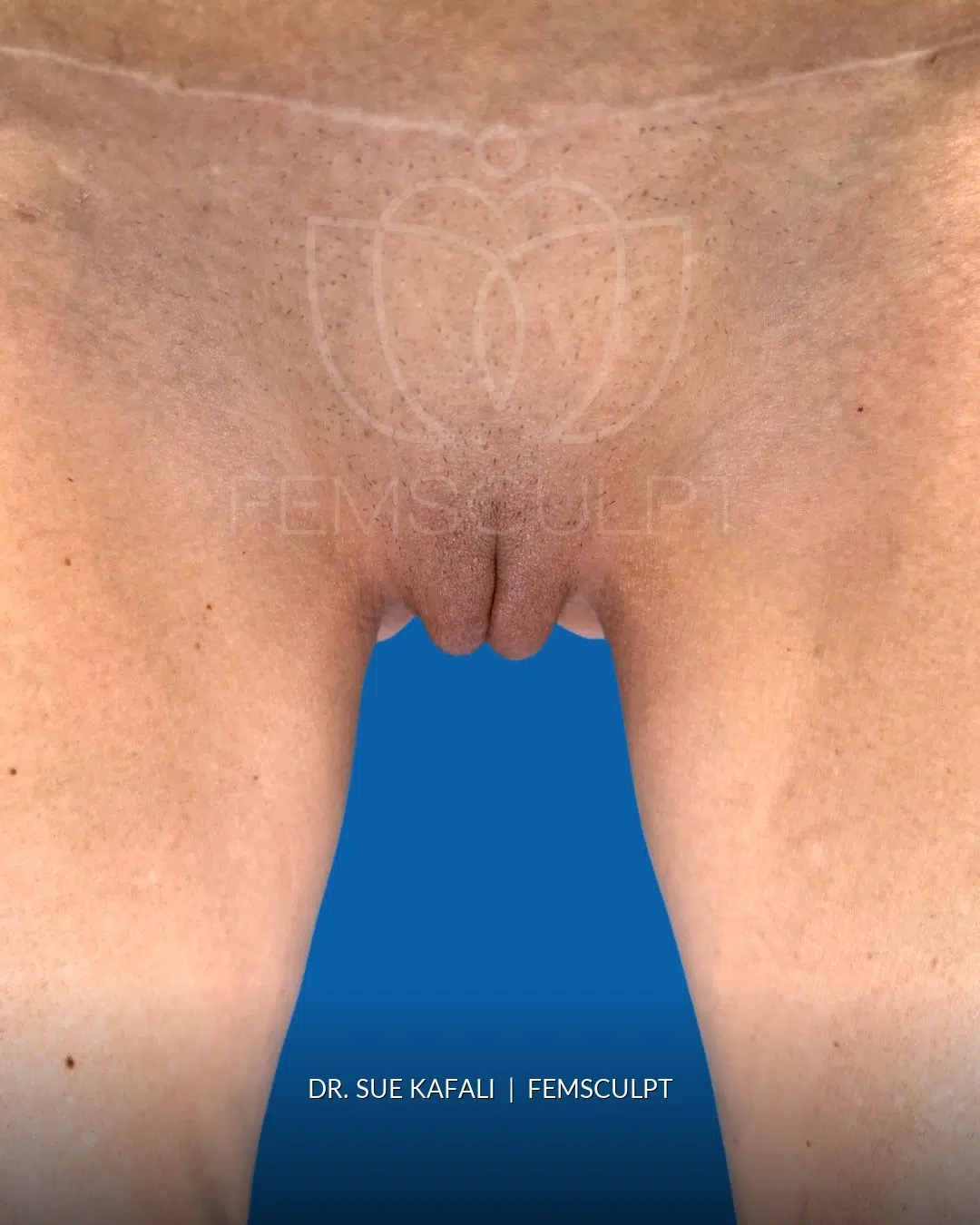 Cleft Narrowing after photo, case MM359, FemSculpt Chicago