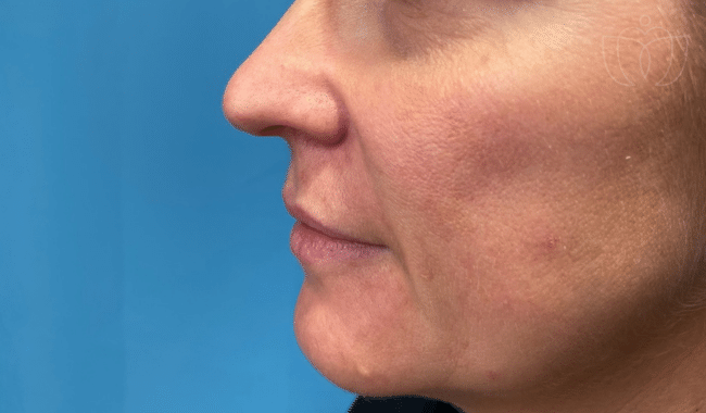 Lip Filler Injections before photo, case 1027, Dr. Sue Kafali, FemSculpt Chicago